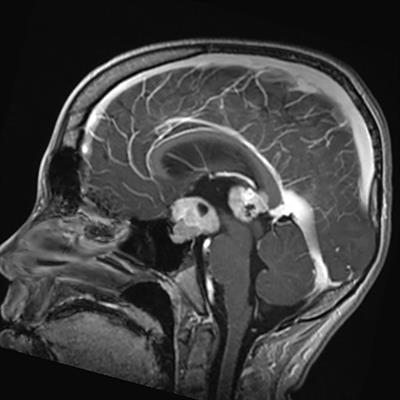 Central nervous system germ cell tumor, an archetypal AYA tumor and a model for pediatric and neuro-oncology collaboration, review from the EURACAN domain 10 group